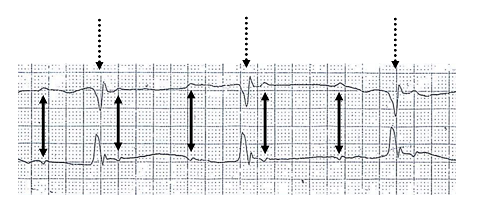 3rd degree heart block image