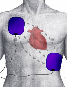 Cardioversion electrode position image