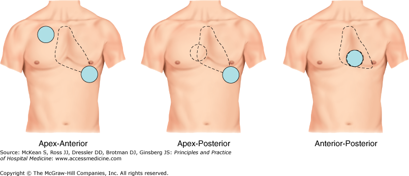 Pad positions for cardioversion