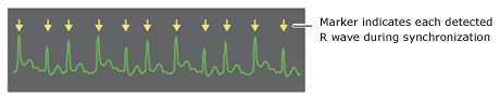 R wave synchronisation