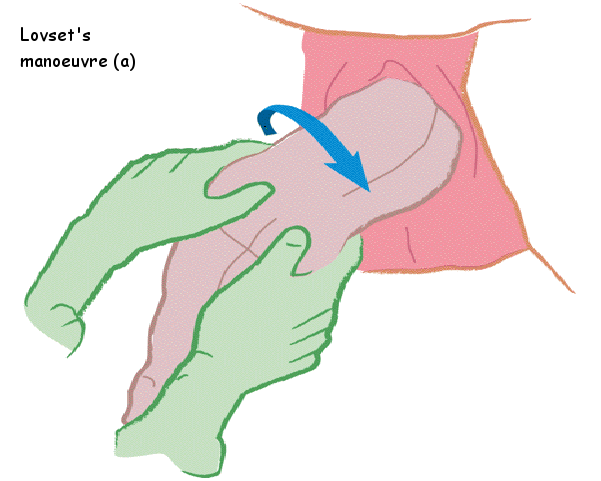 Loveset manoeuvre (a) image