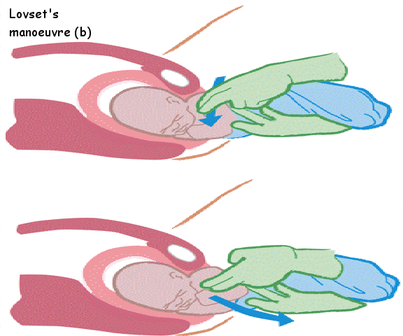 Lovset's manoeuvre (b)