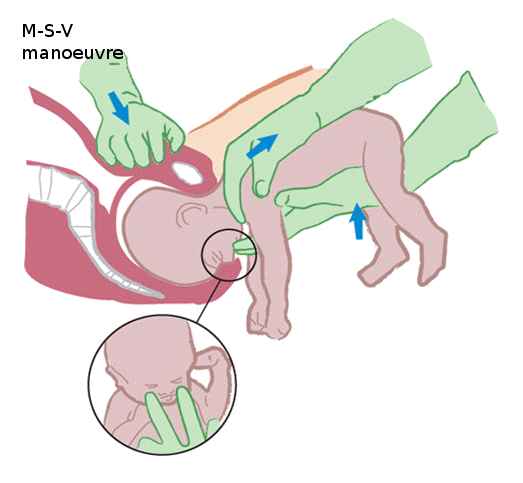 M-S-V manoeuvre image