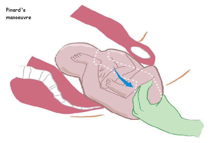 Pinard's manoeuvre image